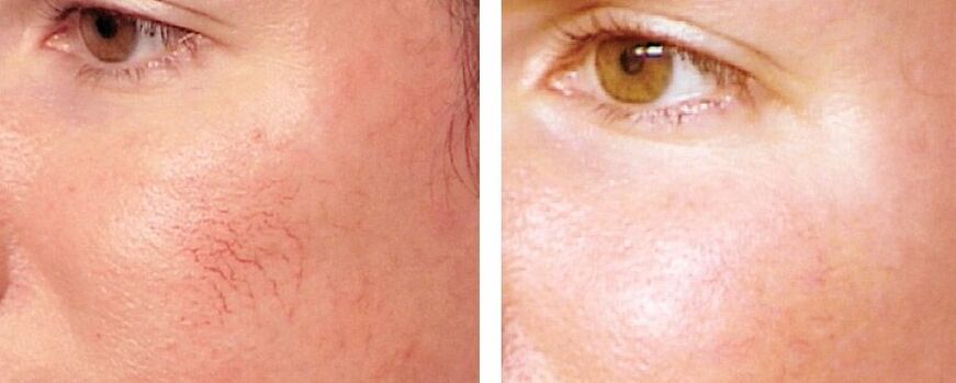 Pembuangan rosacea