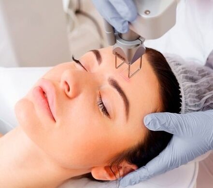 intipati prosedur peremajaan kulit muka laser pecahan