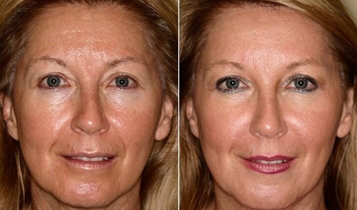 sebelum dan selepas peremajaan kulit wajah di rumah